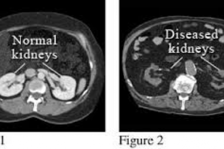 Kidney ultrasound