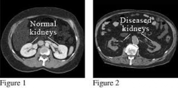 Kidney ultrasound