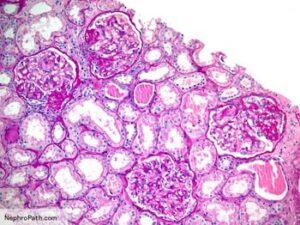 what causes fsgs