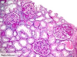 what causes fsgs