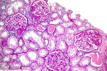 what causes fsgs
