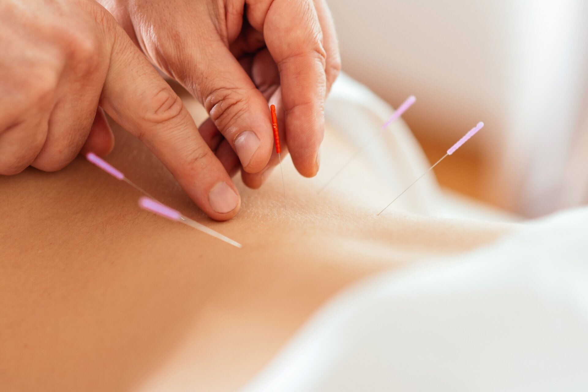 Acupuncture in Kidney Disease