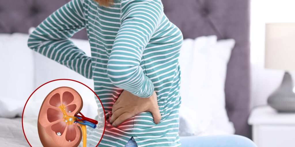 drug-induced kidney stones