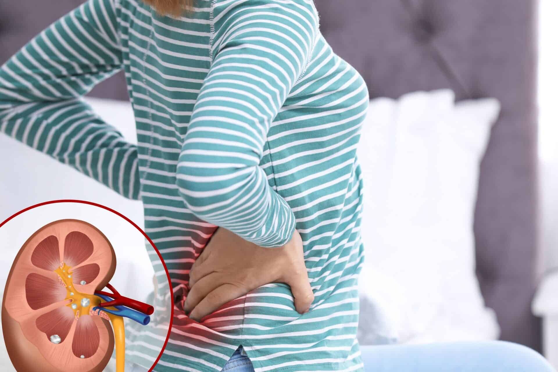 drug-induced kidney stones